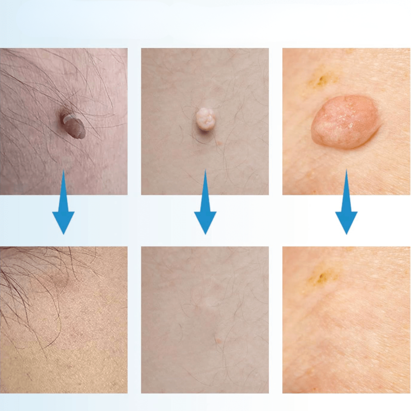 VrorStop Painless Skin Tag Remover for Safe Home Use