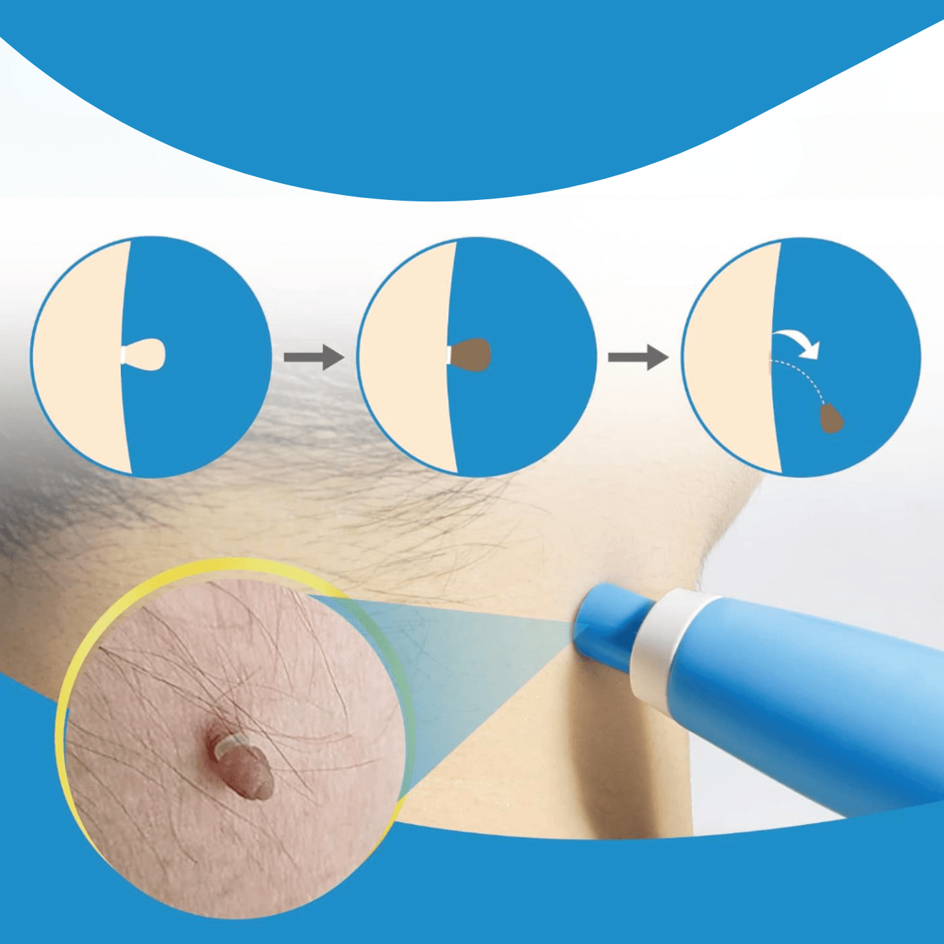 VrorStop Painless Skin Tag Remover for Safe Home Use
