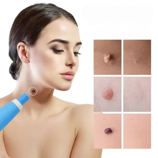 VrorStop Painless Skin Tag Remover for Safe Home Use