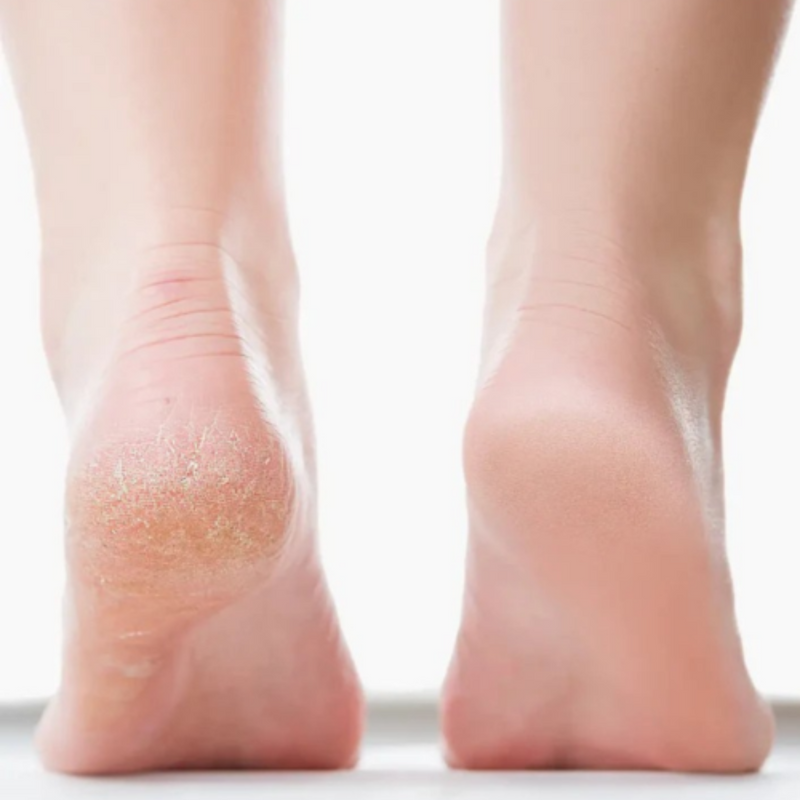 Softstep Electric Foot File for Smooth, Well-Groomed Feet