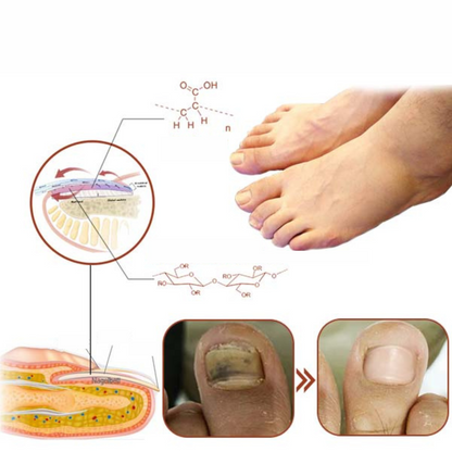 Nailcure Light Treatment for Nail Fungus and Wellness