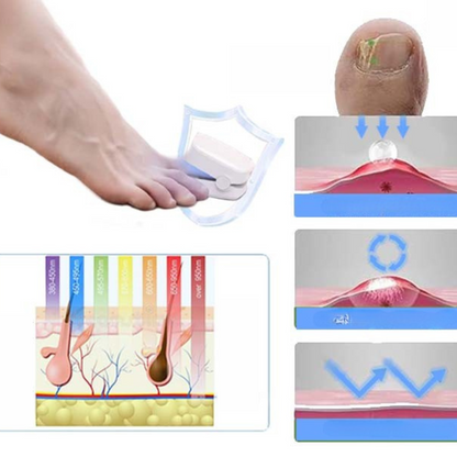 Nailcure Light Treatment for Nail Fungus and Wellness