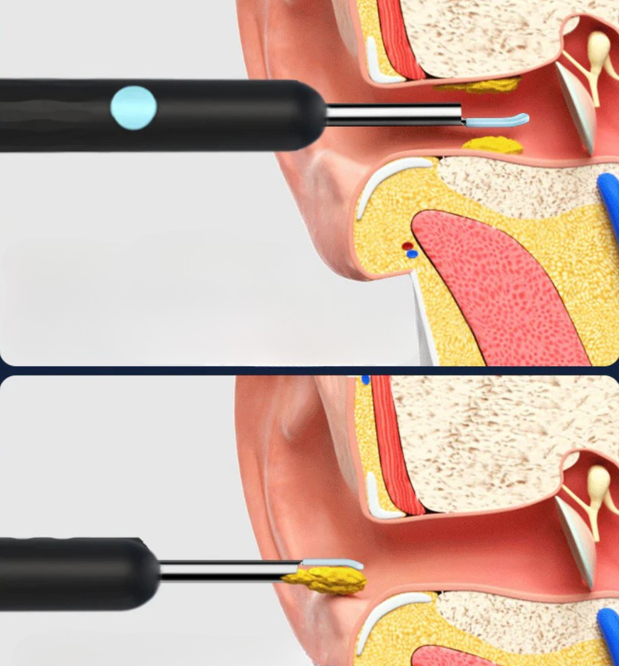 Ravision Pro Ear Camera with Light - Hygienic App Solution